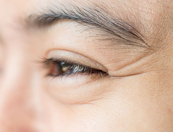 Crow’s Feet Treatment